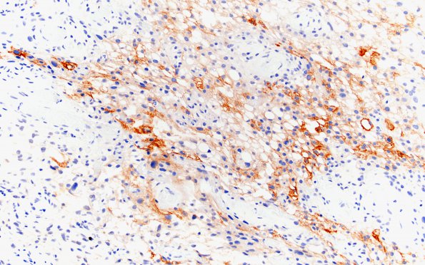 4C4 Meningioma, Microcystic Angiomatous (Case 4) EMA 20Xa