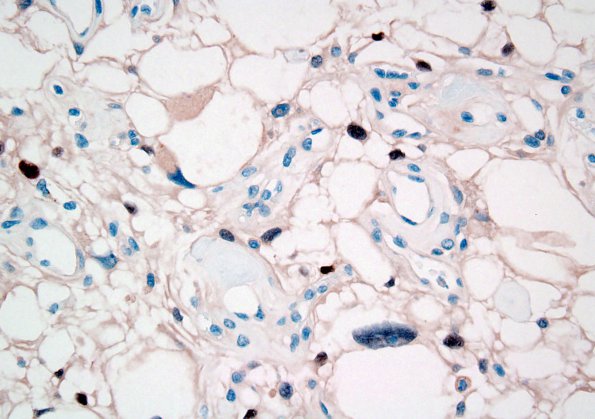 4D Meningioma, Microcystic Angiomatous (Case 4) PR 2.jpg