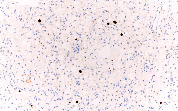 4E Meningioma, Microcystic Angiomatous (Case 4) Ki-67 20X