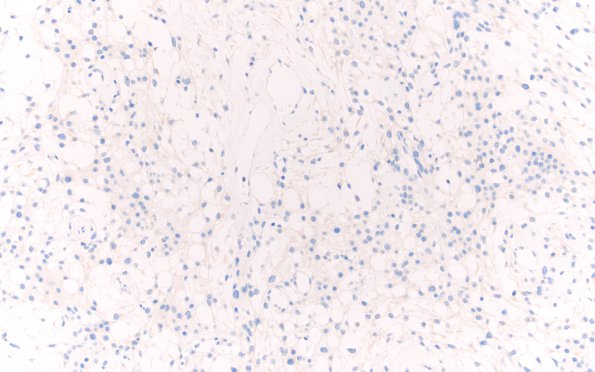 4F Meningioma, Microcystic Angiomatous (Case 4) inhibin 20X