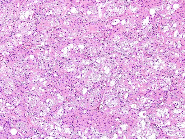 5A1 Meningioma, microcystic (Case 5) H&E 3