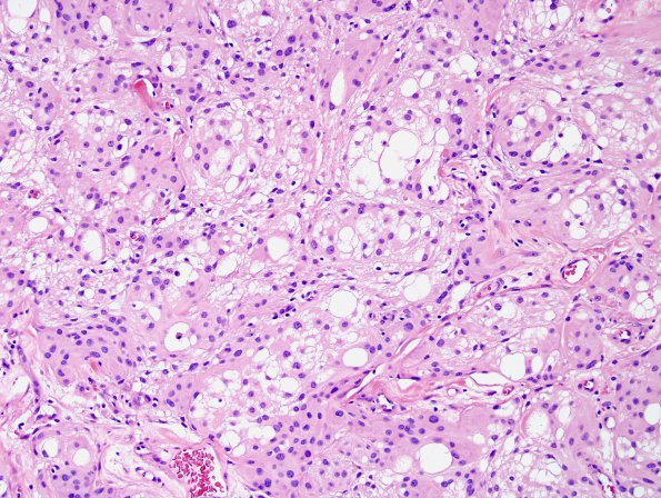 5A2 Meningioma, microcystic (Case 5) H&E 4