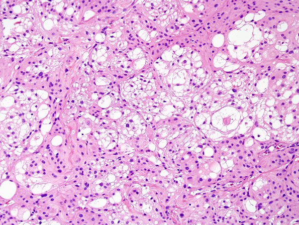 5A3 Meningioma, microcystic (Case 5) H&E 1