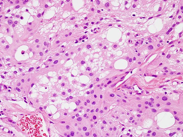 5A4 Meningioma, microcystic (Case 5) H&E 2