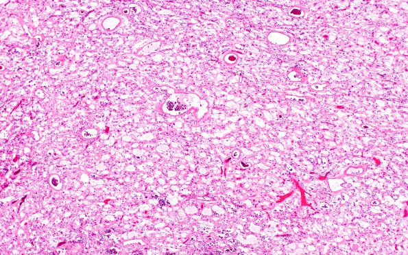 6A1 Meningioma, microcystic (Case 6) H&E 7