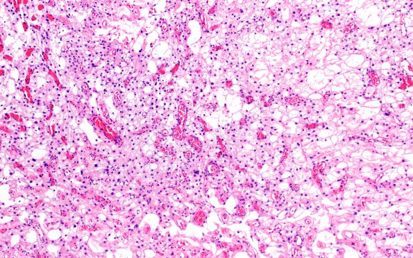 6A2 Meningioma, microcystic (Case 6) H&E 3