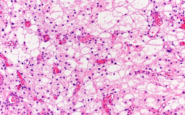 6A3 Meningioma, microcystic (Case 6) H&E 5 (2)