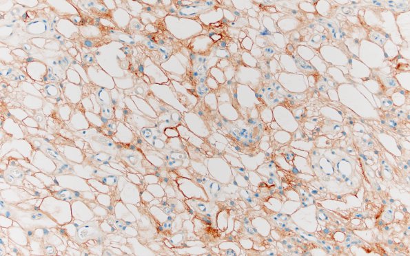 6B2 Meningioma, microcystic (Case 6) EMA 4