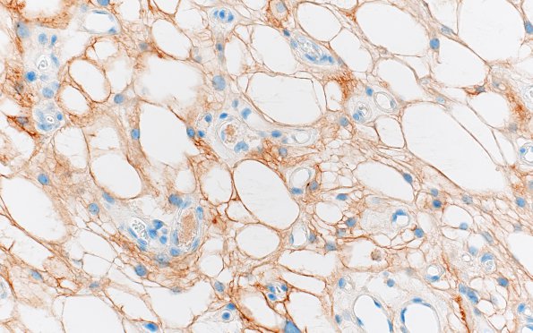 6B3 Meningioma, microcystic (Case 6) EMA 3