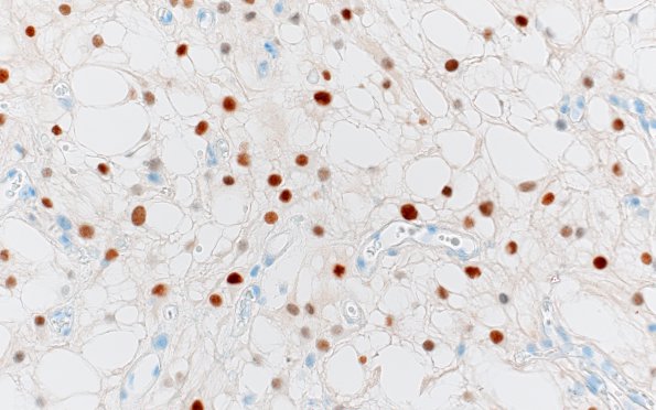 6C Meningioma, microcystic (Case 6) PR 4