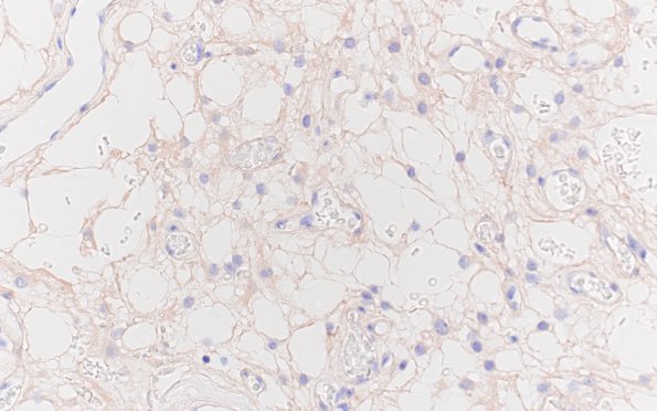 6D Meningioma, microcystic (Case 6) PAX-8 1