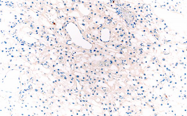 6E Meningioma, microcystic (Case 6) RCC 2