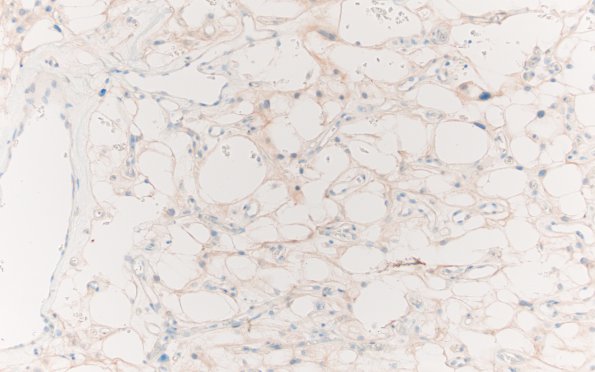 6F Meningioma, microcystic (Case 6) Inhibin 2