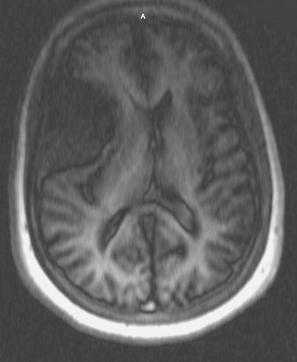 1A2 Meningioma, mucinous (Case 1) - Copy