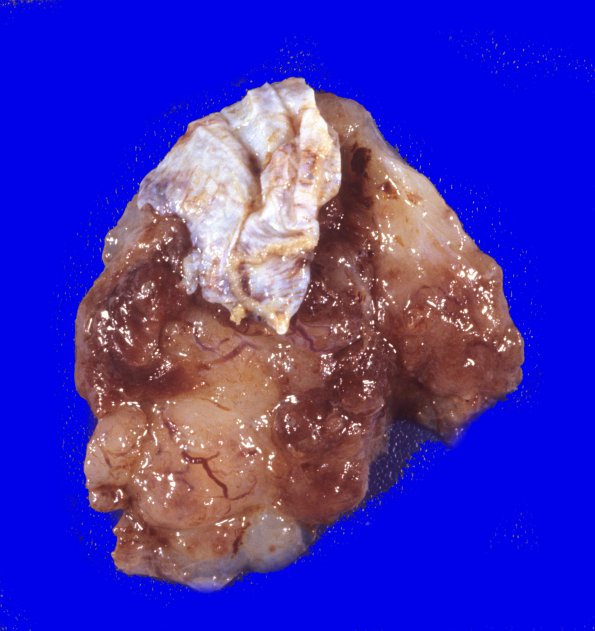 1B1 Meningioma, myxoid (Case 1) 1