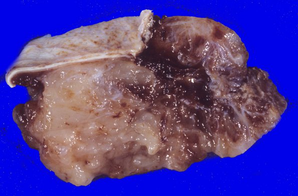 1B2 Meningioma, myxoid (Case 1) 4