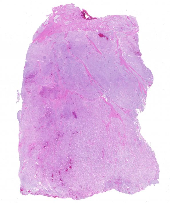 1C1 Meningioma, mucinous (Case 1) H&E whole mount 2