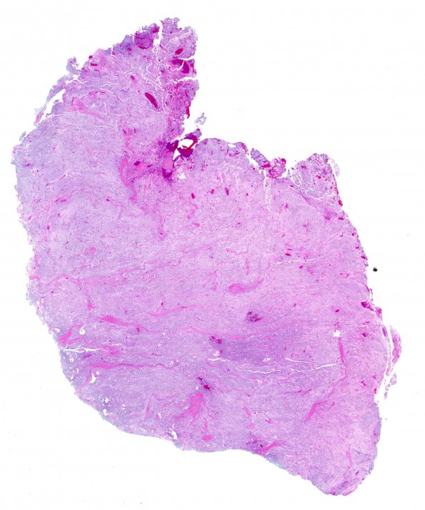 1C2 Meningioma, mucinous (Case 1) 1 H&E WM