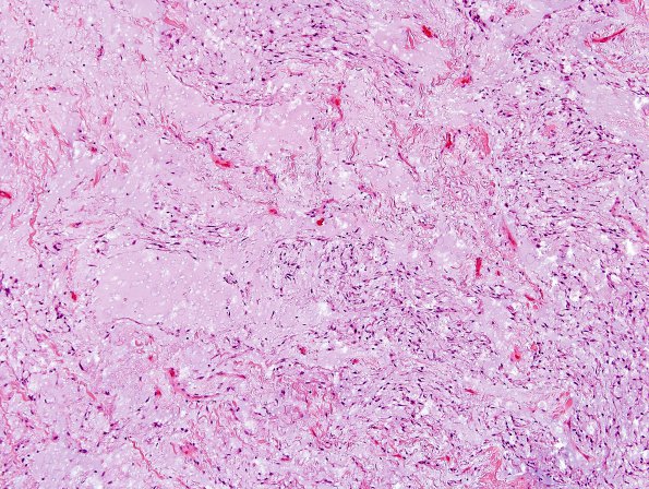 1C3 Meningioma, mucinous (Case 1) H&E 4.jpg