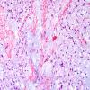 1C4 Meningioma, mucinous (Case 1) H&E 1.jpg