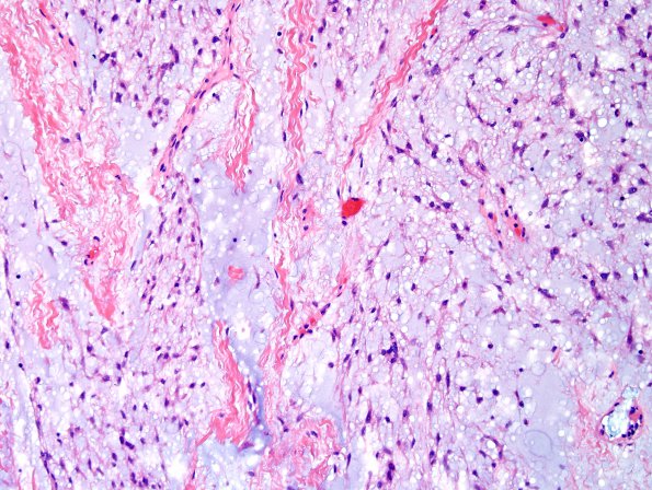 1C4 Meningioma, mucinous (Case 1) H&E 1.jpg