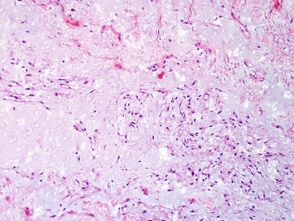 1C5 Meningioma, mucinous (Case 1) H&E 5.jpg