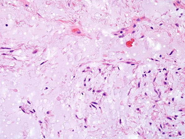 1C6 Meningioma, mucinous (Case 1) H&E 6.jpg