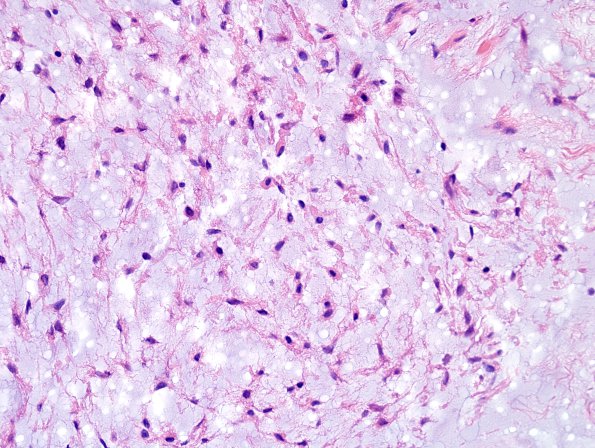 1C7 Meningioma, mucinous (Case 1) H&E 7.jpg