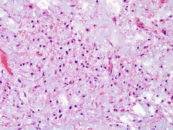 1C8 Meningioma, mucinous (Case 1) H&E 8.jpg