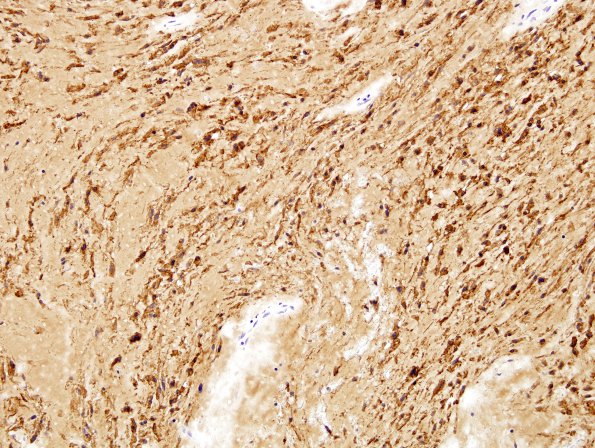 1D3 Meningioma, mucinous (Case 1) EMA 2.jpg