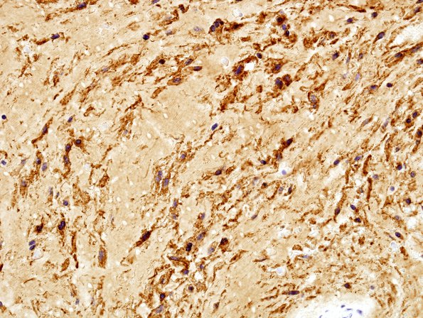 1D4 Meningioma, mucinous (Case 1) EMA 1.jpg