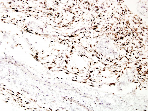 1E2 Meningioma, mucinous (Case 1) PR 3.jpg