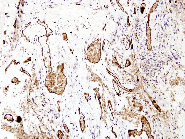 1F Meningioma, mucinous (Case 1) Ulex 1.jpg