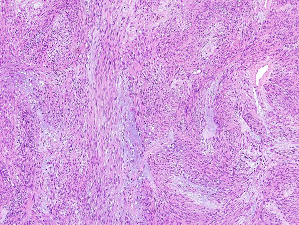 2A1 Meningioma, mucinous (Case 1) H&E 2.jpg