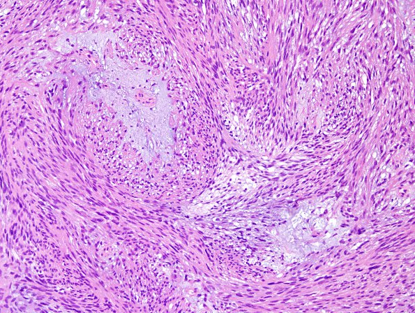 2A2 Meningioma, mucinous (Case 1) H&E 4.jpg