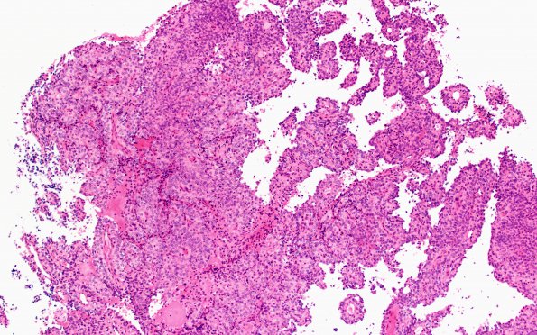 10A1 Meningioma, papillary (Case 10) H&E 10X