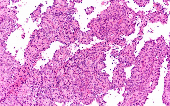 10A2 Meningioma, papillary (Case 10) H&E 20X