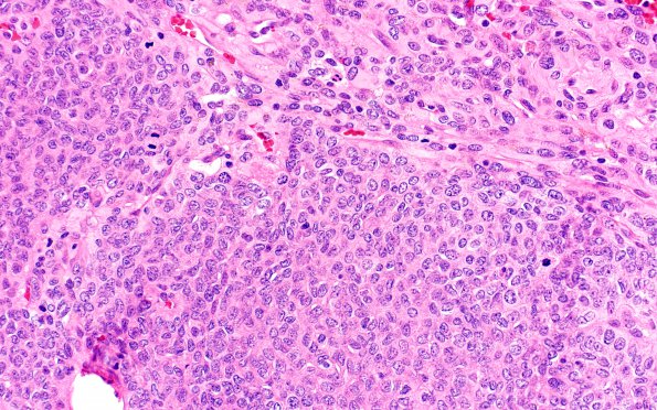 10A3 Meningioma, papillary (Case 10) 40X