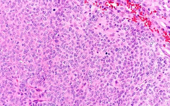 10A4 Meningioma, papillary (Case 10) 40X 2