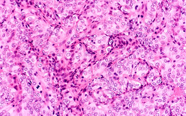 10A5 Meningioma, papillary (Case 10) H&E 40X