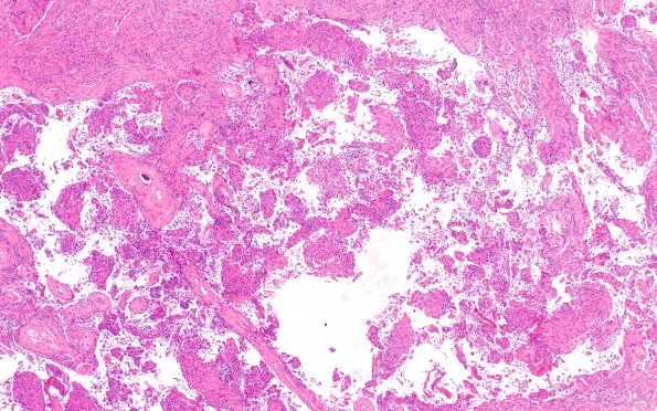 11A1 (Case 11) Focal papillary-rhabdoid H&E 4X