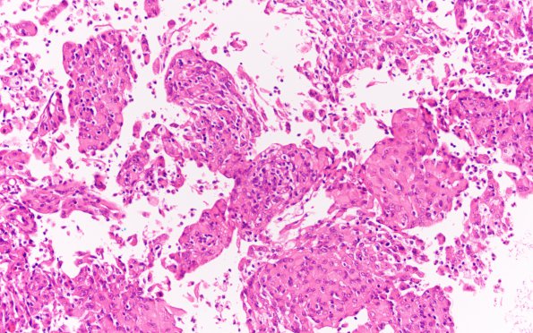 11A2 (Case 11) Focal papillary-rhabdoid H&E 20X