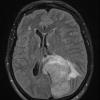 1A1 Meningioma, papillary (Case 1) FLAIR - Copy