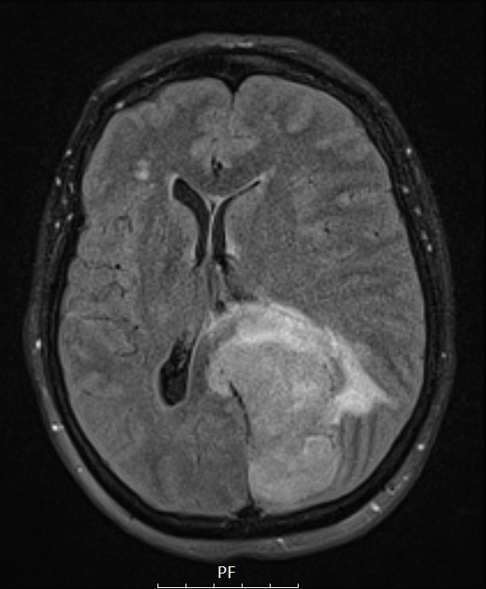 1A1 Meningioma, papillary (Case 1) FLAIR - Copy