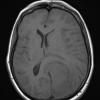 1A2 Meningioma, papillary (Case 1) T1noC - Copy