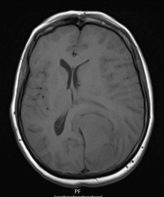 1A2 Meningioma, papillary (Case 1) T1noC - Copy