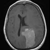 1A3 Meningioma, papillary (Case 1) T1W - Copy