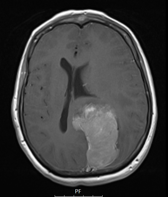 1A3 Meningioma, papillary (Case 1) T1W - Copy