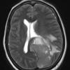 1A4 Meningioma, papillary (Case 1) T2W - Copy