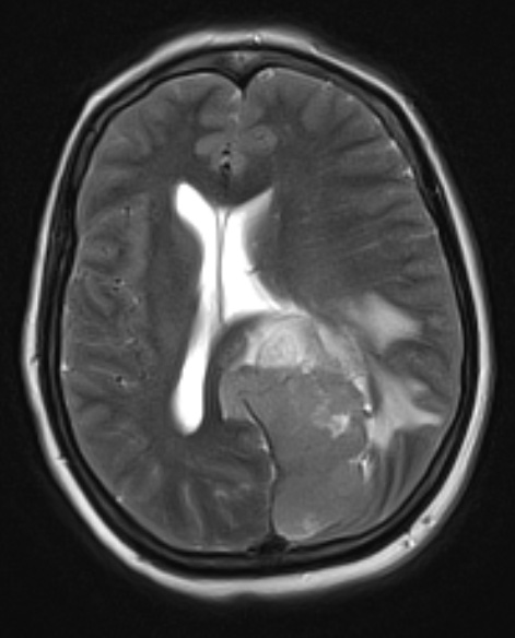 1A4 Meningioma, papillary (Case 1) T2W - Copy